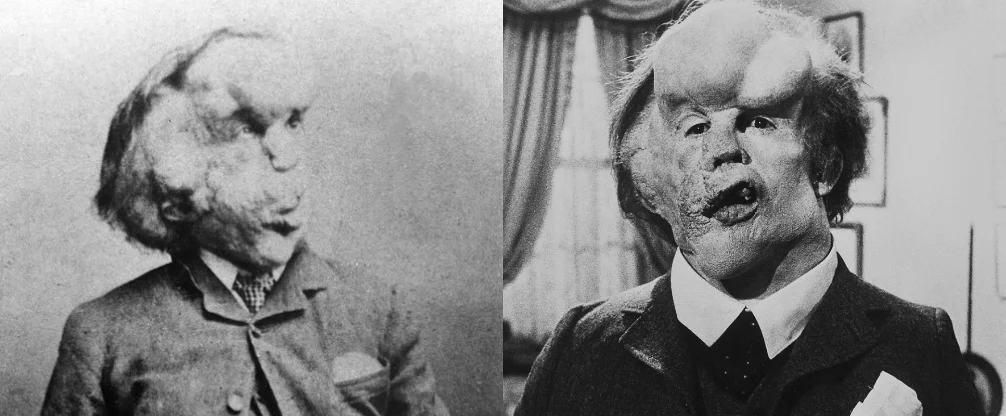 Spotlight-0626-7-wikiPressbook Joseph Merrick and John Merrick (John Hurt). Source: Wikimedia Commons and Screengrab from film